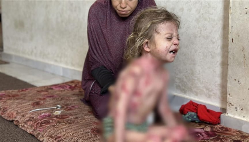 Vogëlushja Nur nga Gaza e cila vuan nga një sëmundje e rrallë po pret për trajtim